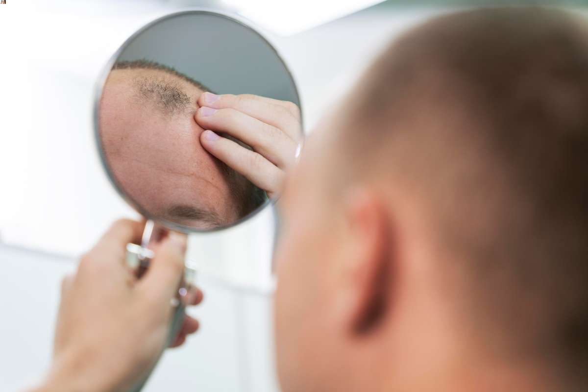 Jak powstrzymać łysienie androgenowe typu męskiego?